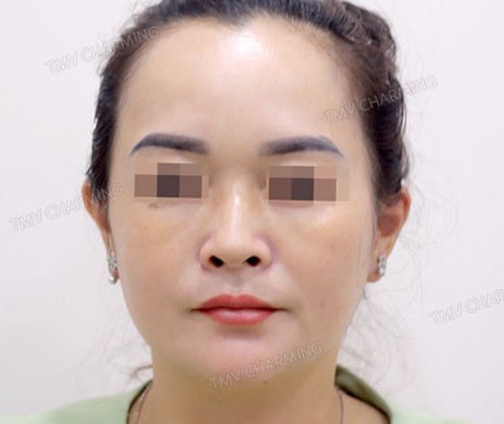 Mũi lót sụn – cắt cánh – cà gồ