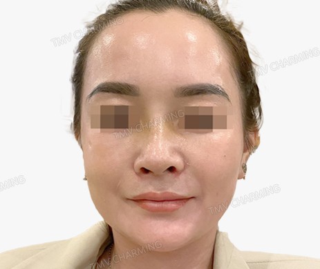 Mũi lót sụn – cắt cánh – cà gồ