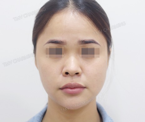 Mũi lót sụn – thu chóp