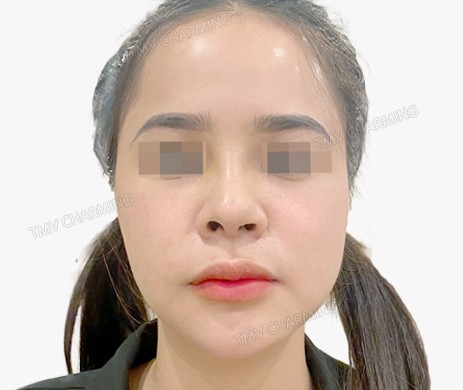 Mũi lót sụn – thu chóp