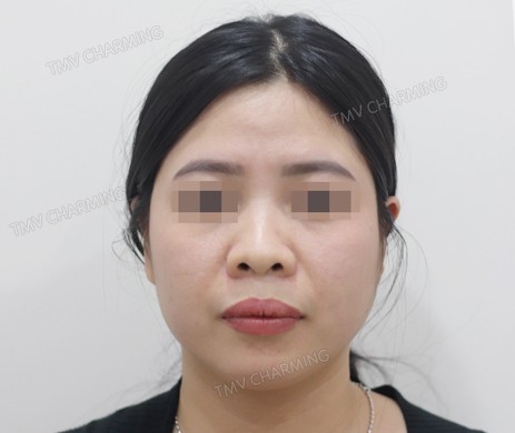 Mũi lót sụn – cắt xương – Độn cằm