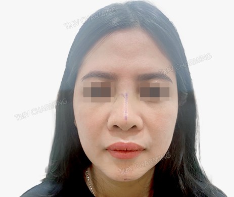 Mũi lót sụn – cắt xương – Độn cằm