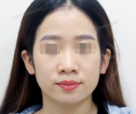 Mũi lót sụn – cắt cánh