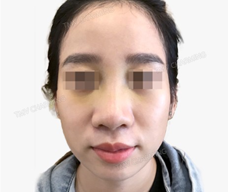 Mũi lót sụn – cắt cánh