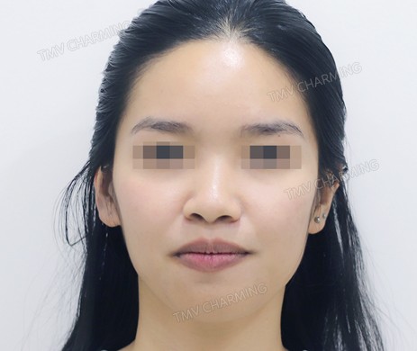 Mũi lót sụn – cắt cánh – thu chóp