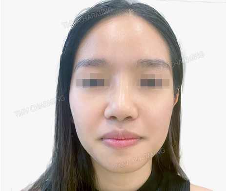 Mũi lót sụn – cắt cánh – thu chóp