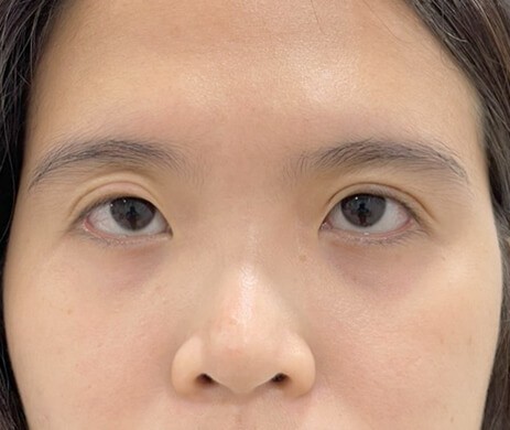 Cấy mỡ mí trên