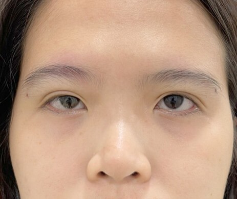 Cấy mỡ mí trên