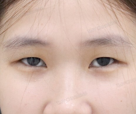 Nhấn mí – Mở góc mắt