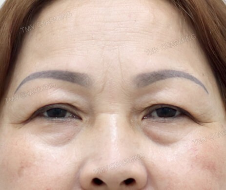 Cắt mí trên – mí dưới