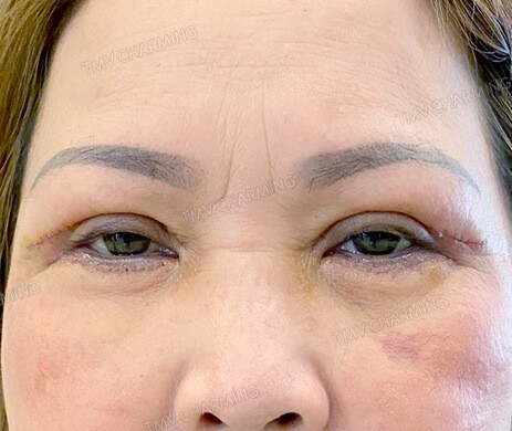Cắt mí trên – mí dưới