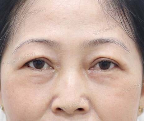 Cắt mí trên – mí dưới