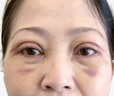 Cắt mí trên – mí dưới