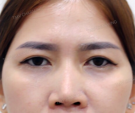 Cấy mỡ mí dưới