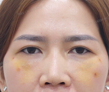 Cấy mỡ mí dưới