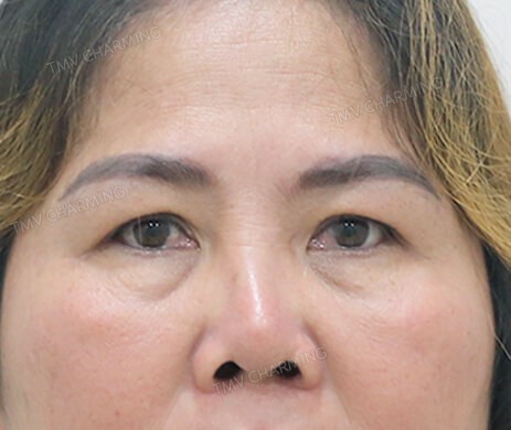 Cắt mí trên – mí dưới
