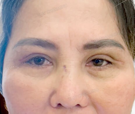Cắt mí trên – mí dưới