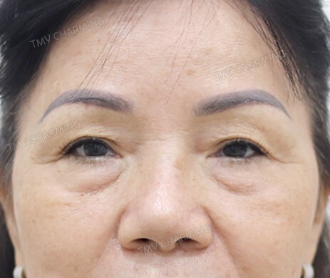 Cắt mí trên – mí dưới