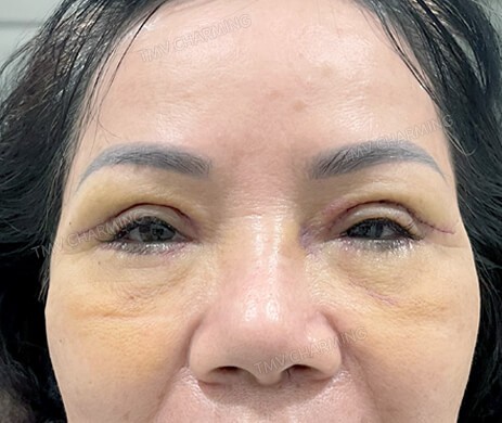 Cắt mí trên – mí dưới