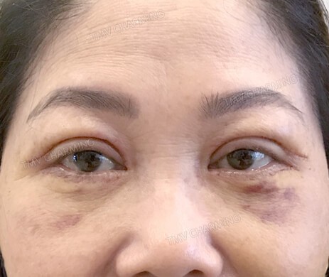 Cắt mí trên – mí dưới