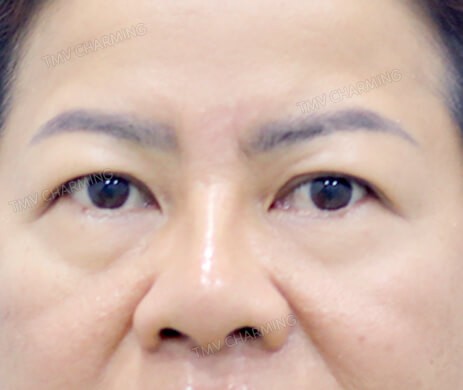 Cắt mí trên – mí dưới