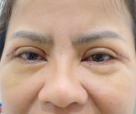 Cắt mí trên – mí dưới