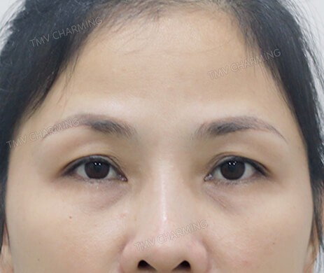 Treo cung mày – Cắt mí dưới