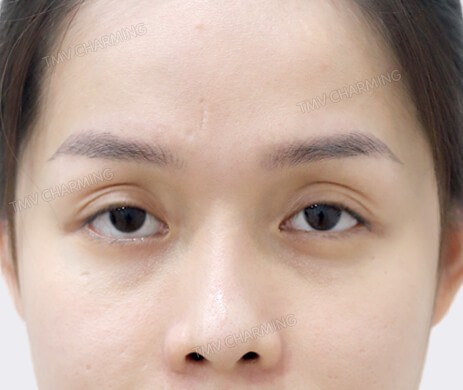 Cấy mỡ mí trên – dưới