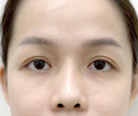 Cấy mỡ mí trên – dưới