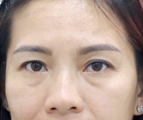 Cắt mí trên – mí dưới