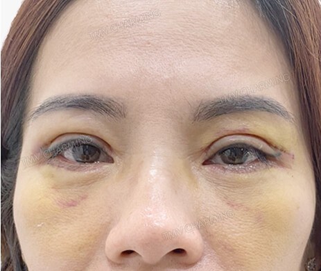 Cắt mí trên – mí dưới