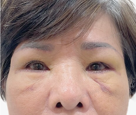 Treo cung mày – Cắt mí dưới