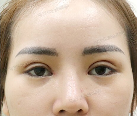 Cắt mí trên – Mở góc mắt