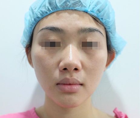 Mũi cấu trúc sụn sườn – cắt xương 1 tháng