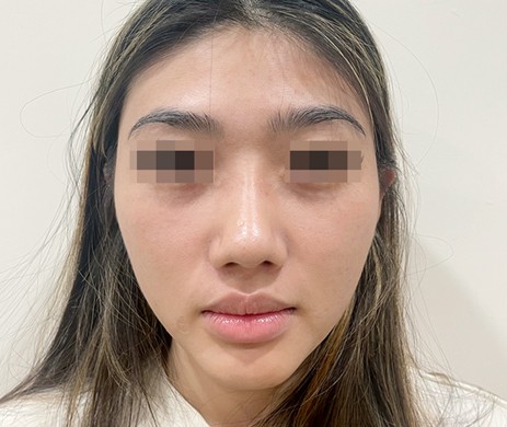 Mũi cấu trúc sụn sườn – cắt xương 1 tháng