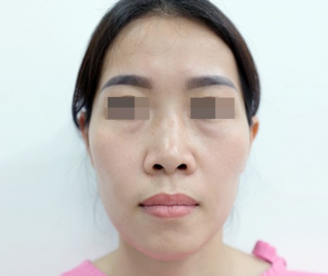 Mũi cấu trúc sụn sườn – cắt xương – cắt cánh