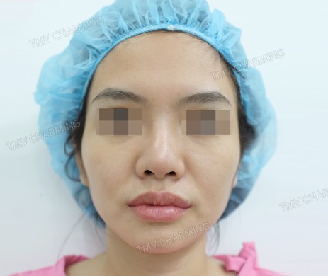 Mũi cấu trúc sụn sườn sửa lại – cắt xương – cắt cánh