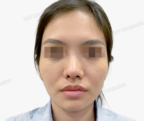 Mũi cấu trúc sụn sườn sửa lại – cắt xương – cắt cánh