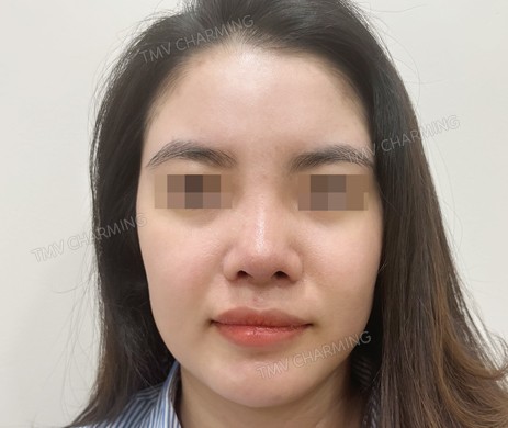 Mũi cấu trúc sụn sườn sửa lại – cắt cánh