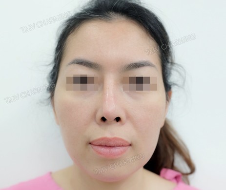 Mũi cấu trúc sụn sườn sửa lại – cắt xương