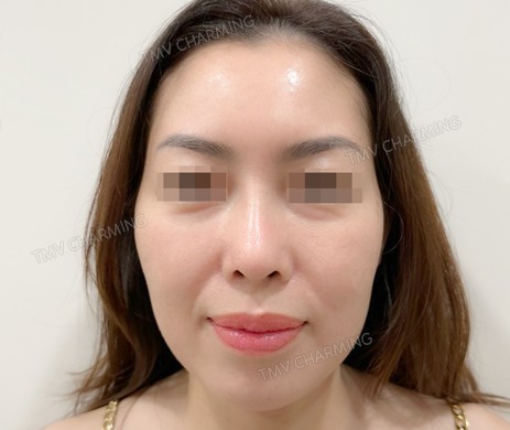 Mũi cấu trúc sụn sườn sửa lại – cắt xương