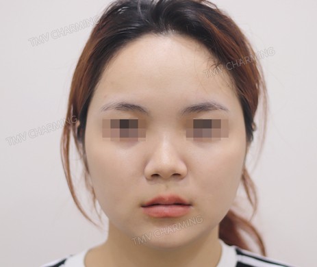 Mũi lót sụn – cắt cánh