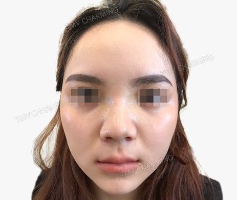 Mũi lót sụn – cắt cánh