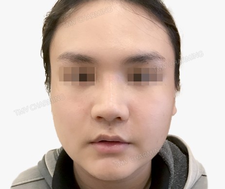 Mũi lót sụn – cắt cánh – cắt xương