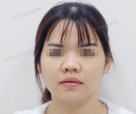 Mũi lót sụn –  cắt xương