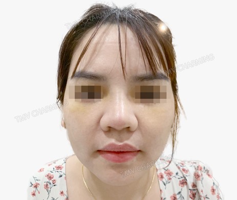 Mũi lót sụn –  cắt xương