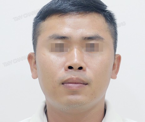 Mũi lót sụn – cắt xương