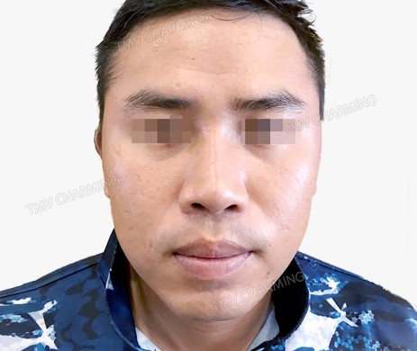 Mũi lót sụn – cắt xương