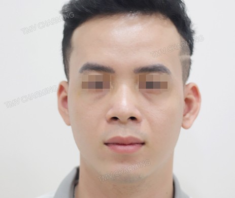 Mũi lót sụn – cắt cánh – cắt xương