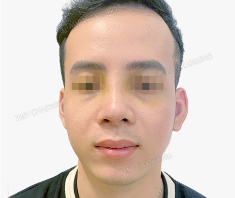 Mũi lót sụn – cắt cánh – cắt xương